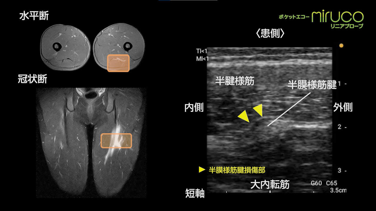 肉ばなれ アキレス腱断裂編 腓腹筋内側頭肉ばなれ ハムストリング肉ばなれ アキレス腱断裂 ポケットエコー Miruco スポーツ現場で遭遇する症例 日本シグマックス整形外科領域 総合情報サイト Sigmax Medical